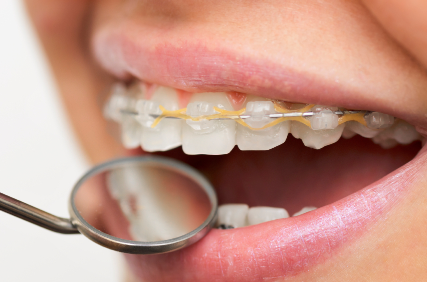 Quanto dura un intero trattamento ortodontico? - Dentista Italiano
