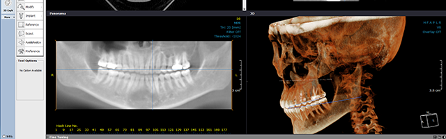 Imaging dentale 3D in implantologia dentale