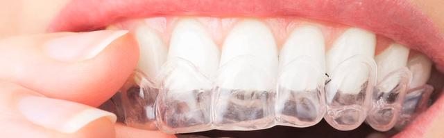 Apparecchio ortodontico InvisalignⓇ