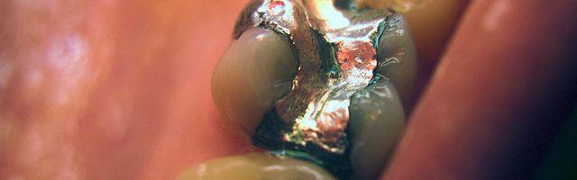 Le tipologie di otturazioni dentali – vantaggi e svantaggi