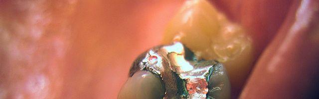 Silver or aestetic dental fillings?