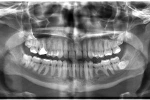Dental X-Rays