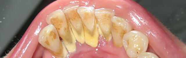 Perché la carie mi ha rovinato i denti cosi improvvisamente?