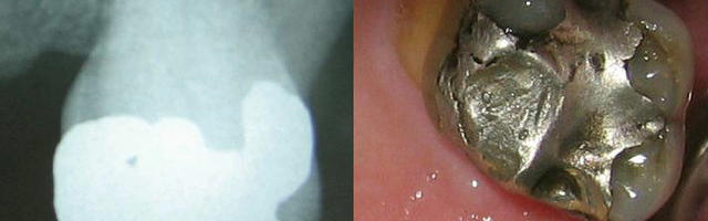 Le tipologie di otturazioni dentali – vantaggi e svantaggi