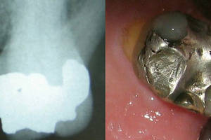 Le tipologie di otturazioni dentali – vantaggi e svantaggi
