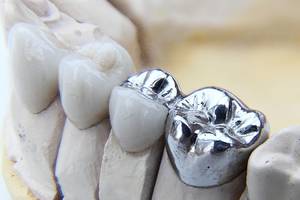 How Long Does a Dental Bridge Last?