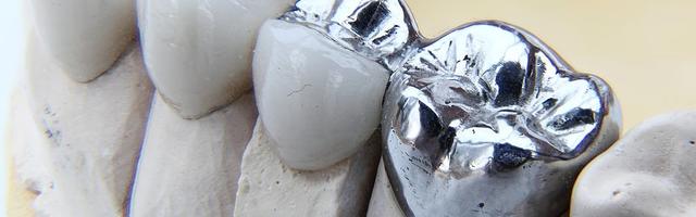 How Long Does a Dental Bridge Last?