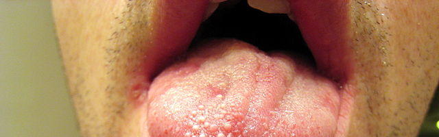 Bocca secca: cause, sintomi e rimedi