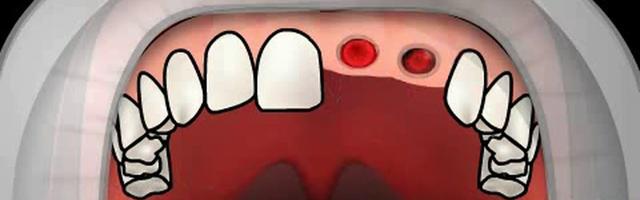 Dry Socket or Alveolitis