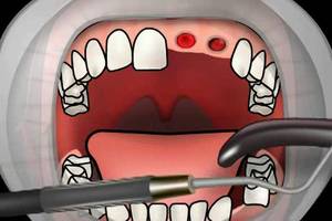 Dry Socket or Alveolitis