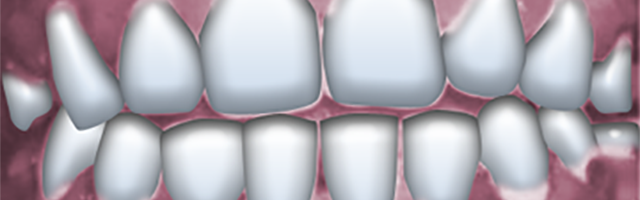 Lo spettro dell’emorragia