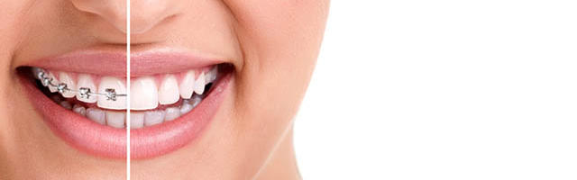 Non chiamarmi piú bocca di ferro!