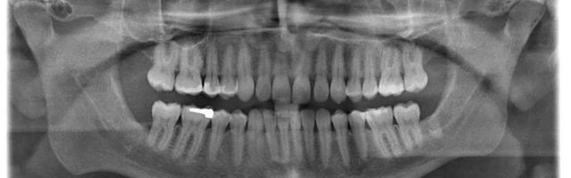 Ricostruzione ossea dentale