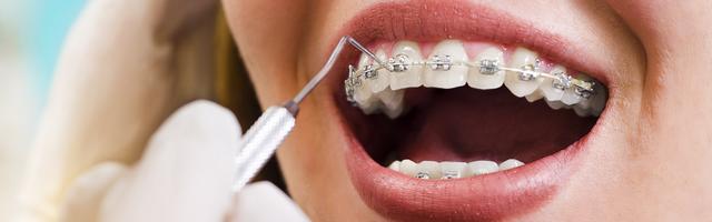 L’ortodonzia in età adulta