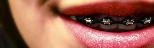 How To Clean Your Braces