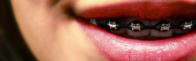 Orthodontics: A Short FAQ