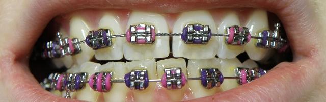 Trattamento ortodontico: guida di sopravvivenza