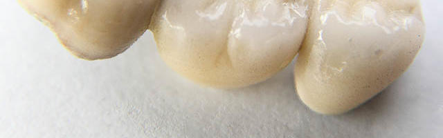 La corona dentale provvisoria, che cos’è?