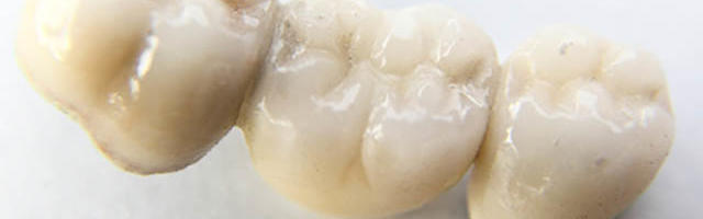 Perché scegliere un ponte dentale?