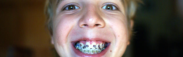 When To Start Our Child’s Orthodontic Treatment?