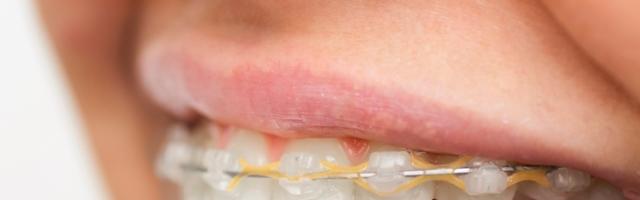 Dental Braces After 40