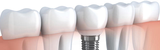 How Long Do Dental Implants Last?