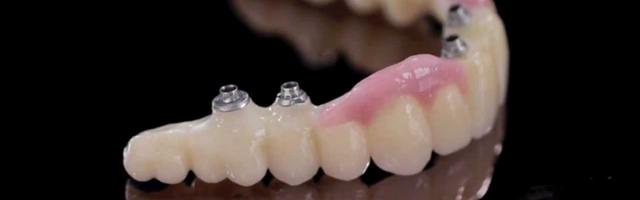 Tooth Replacements- Bridge Or Dental Implant? (part2)