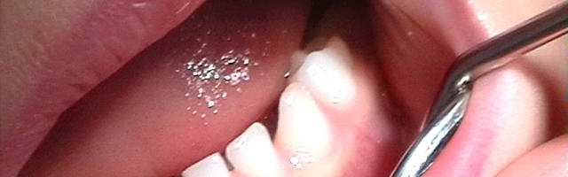 I denti decidui sono deboli e difettosi?