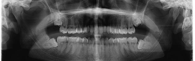 I denti del giudizio sono necessari?