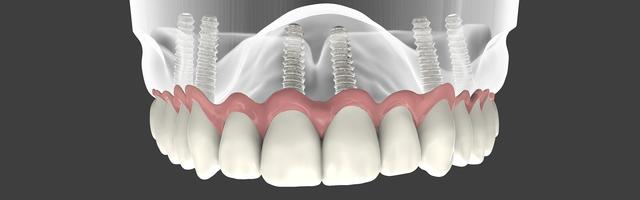 Mini Implants To Replace An Entire Row Of Teeth