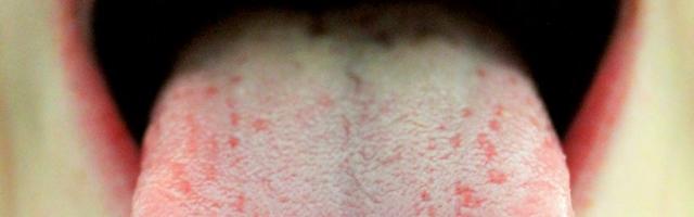 How To Avoid Dry Mouth