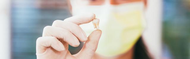 Root Canal Treatment Or Extraction?