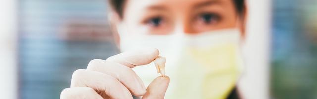 Dopo l’estrazione di un dente del giudizio