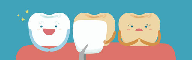 Che cosa sono le faccette di ceramica