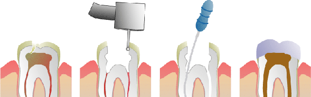 Vita di un dente devitalizzato