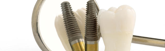 Who Is The Best Dental Implant Manufacturer?