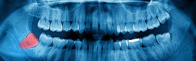 Il tormento dei denti del giudizio