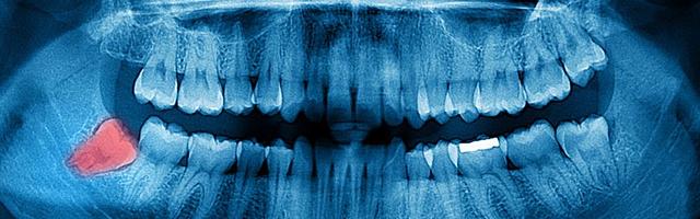 Il tormento dei denti del giudizio