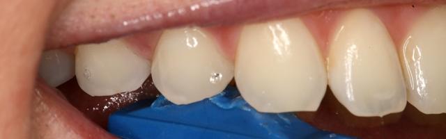 Il dolore gengivale e ai denti quando si mastica