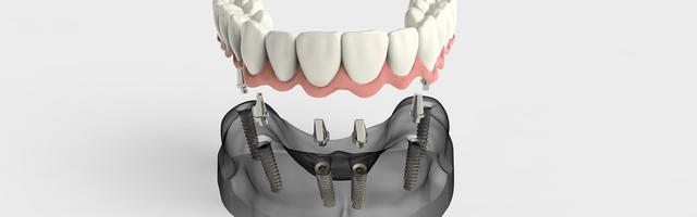 3D Imaging In Implantology