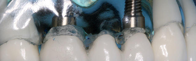 Ancient Dental Implants