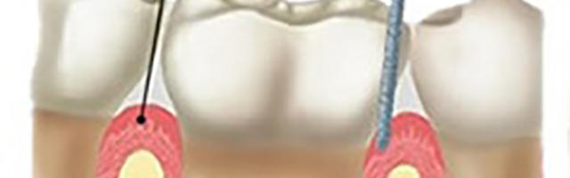 Dolore dentale e infiammazione