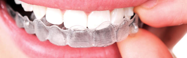 Quanto sono efficaci gli allineatori invisibili?