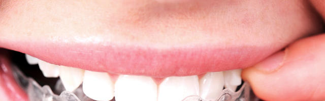 La routine quotidiana ideale di Invisalign® con Giulia
