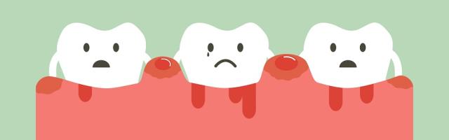 Rimedi naturali per la cura della gengivite, erbe curative per la saluta dei denti
