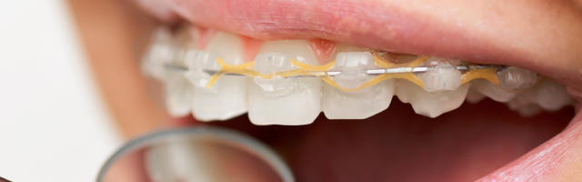 How Long Does Orthodontic Treatment Take?
