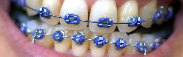 Orthodontic Treatment Survival Guide