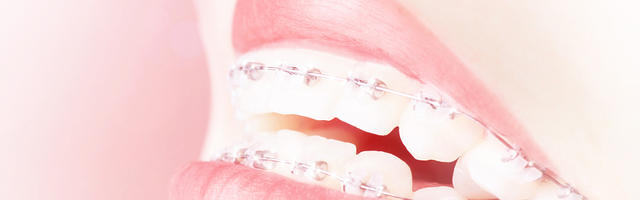 Ortodonzia: Una breve FAQ