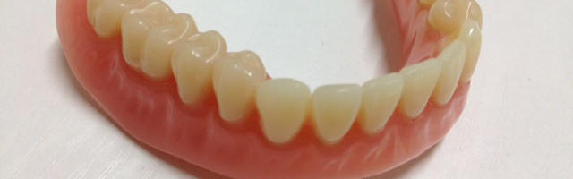 Che cos’e’ l’overdenture mandibolare su impianti?