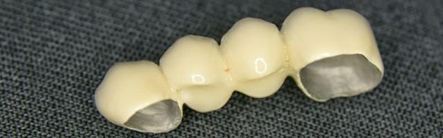 Come si preparano i ponti dentali?